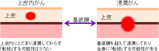上皮内がん・湿潤がん