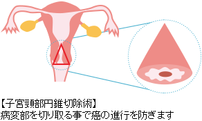 子宮頸部円錐切除術