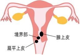 腺がん