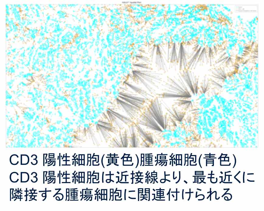 CD3陽性細胞(黄色)腫瘍細胞(青色)