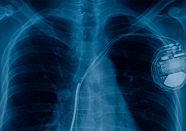 X-ray image of a human chest showing a biocompatible implanted medical device, such as a pacemaker, with leads extending into the heart area—illustrating safe integration of medical technology within the body.