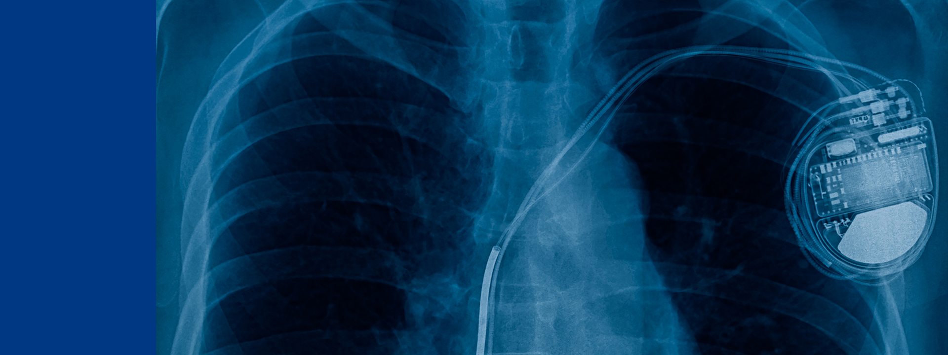  X-ray image of a human chest showing a biocompatible implanted medical device, such as a pacemaker, with leads extending into the heart area—illustrating safe integration of medical technology within the body.