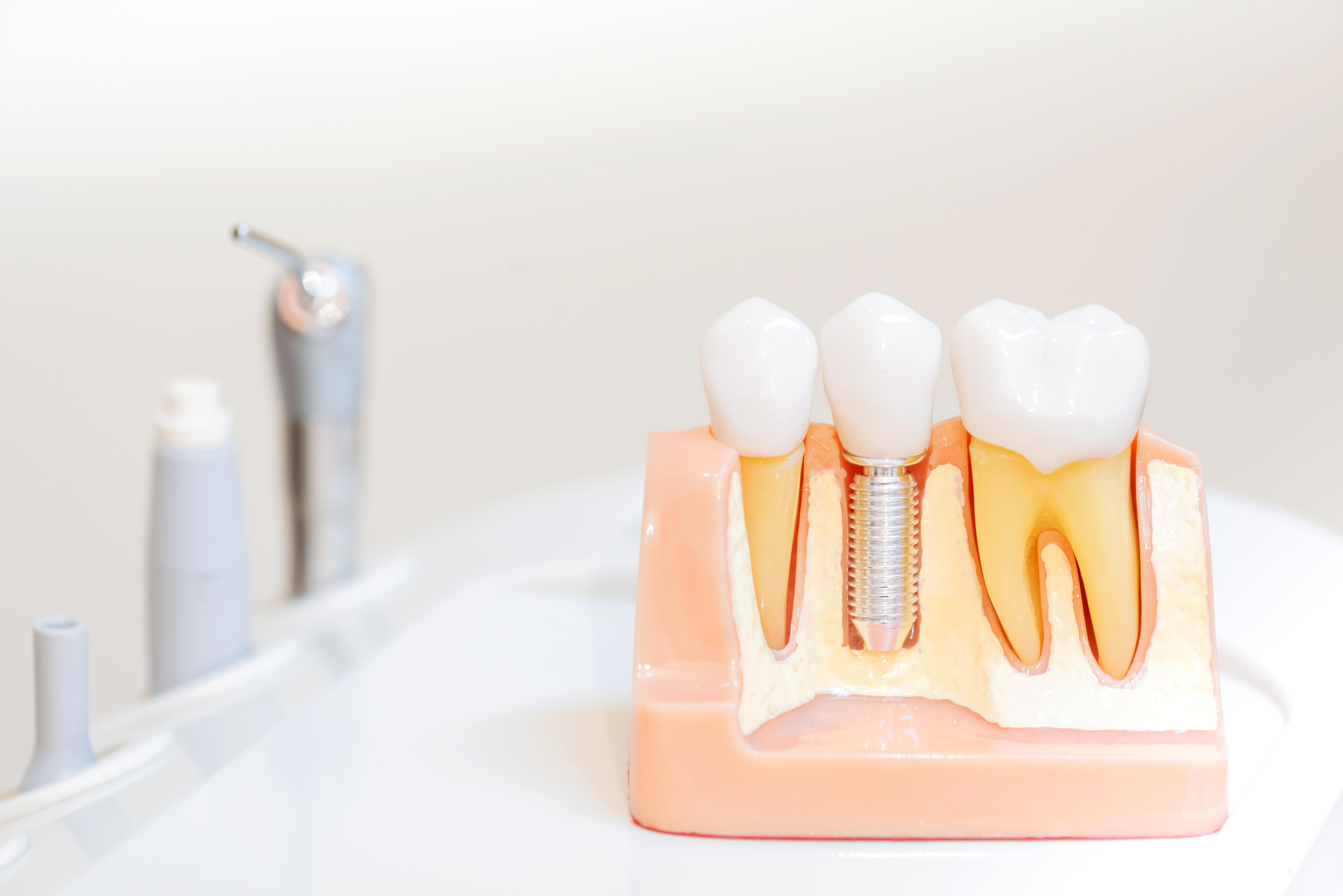 tooth-implant-false-teeth-dentistry-and-healthcare-concept-at-dental-clinic