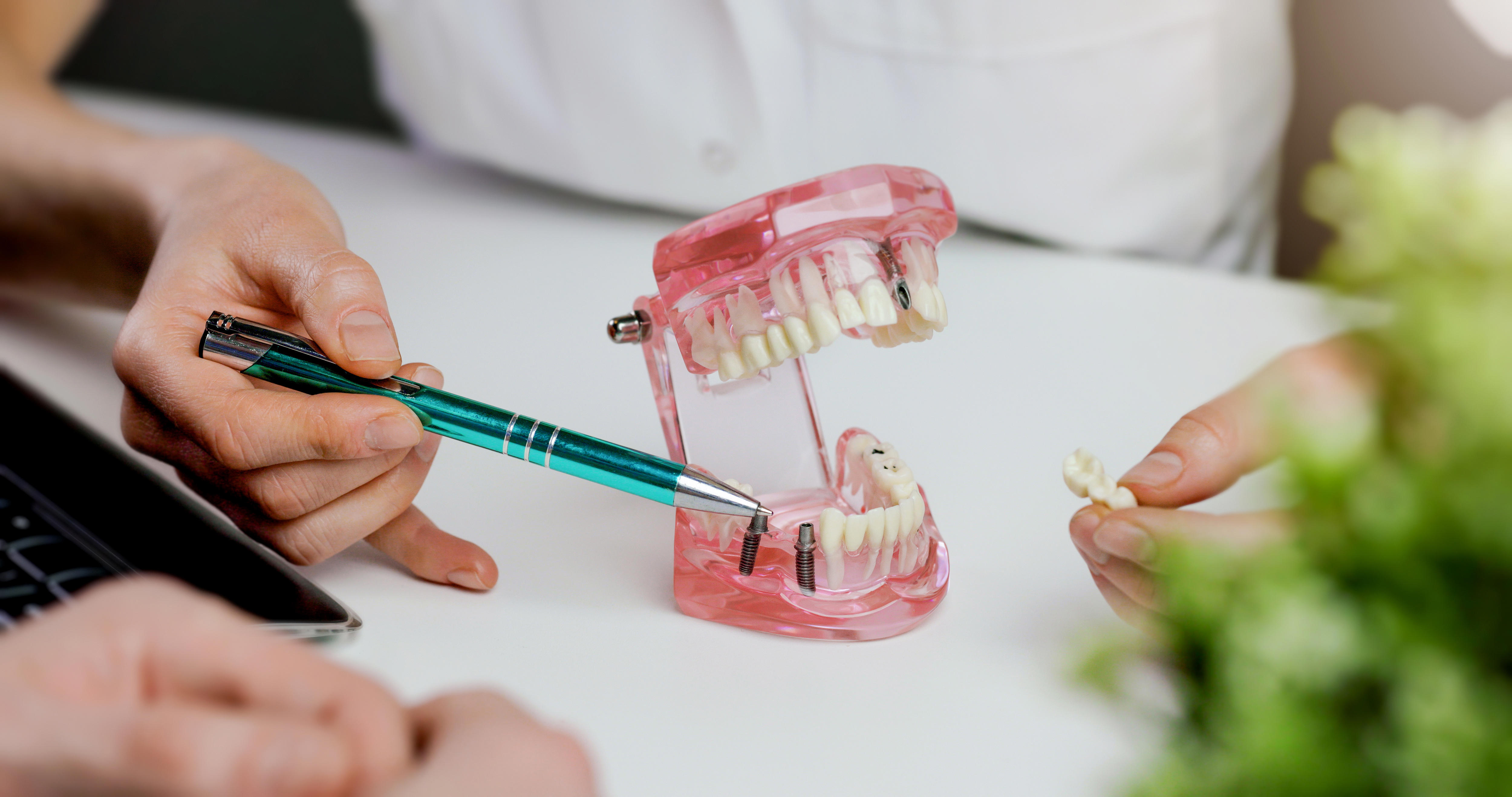 dentist-implantologist-showing-dental-implant-technology-on-tooth-jaw-model-to-patient-visit-in-clinic-office