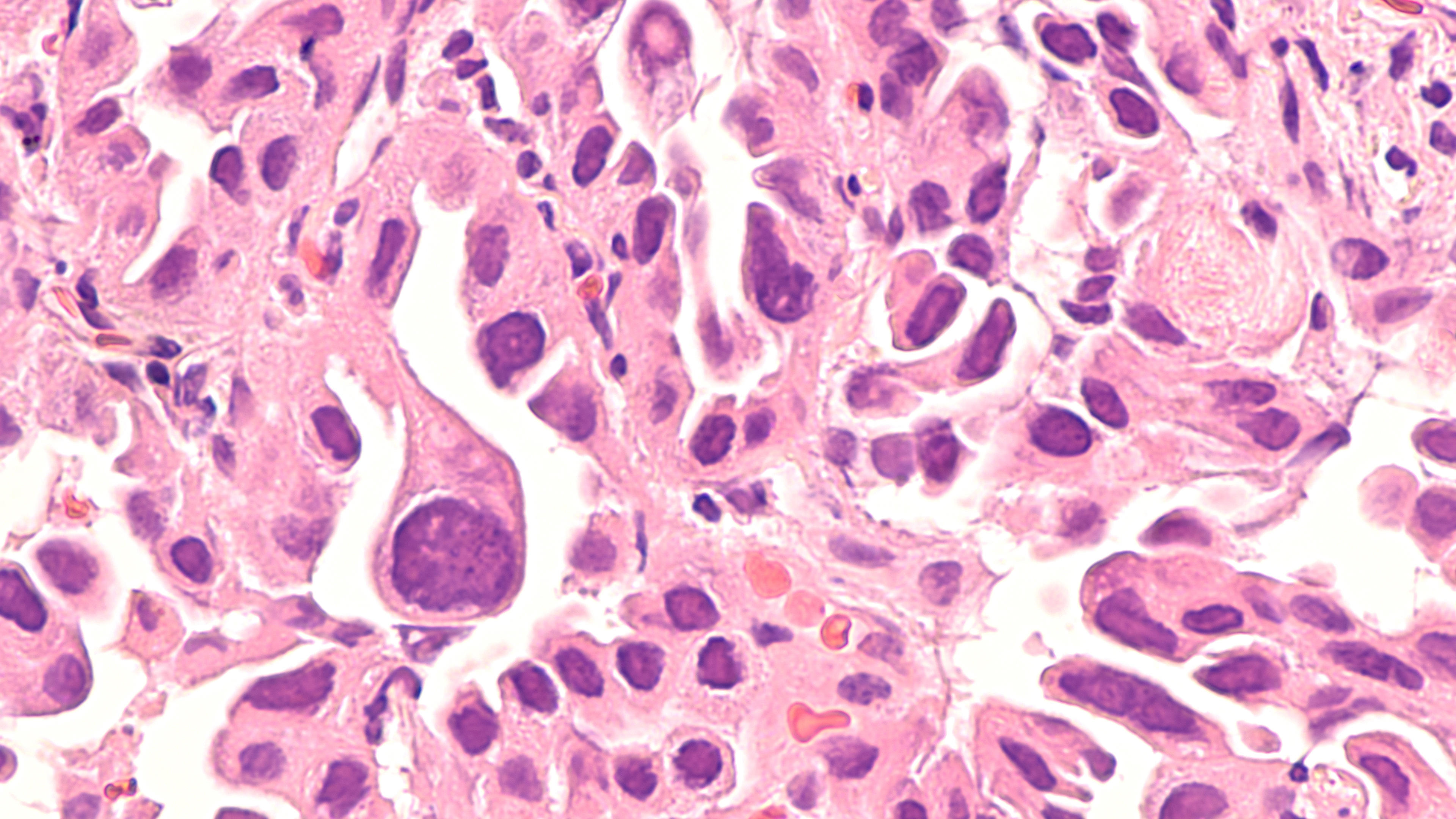 lung-cancer-adenocarcinoma-therapies-for-specific-genetic-mutations_adobestock_279700585