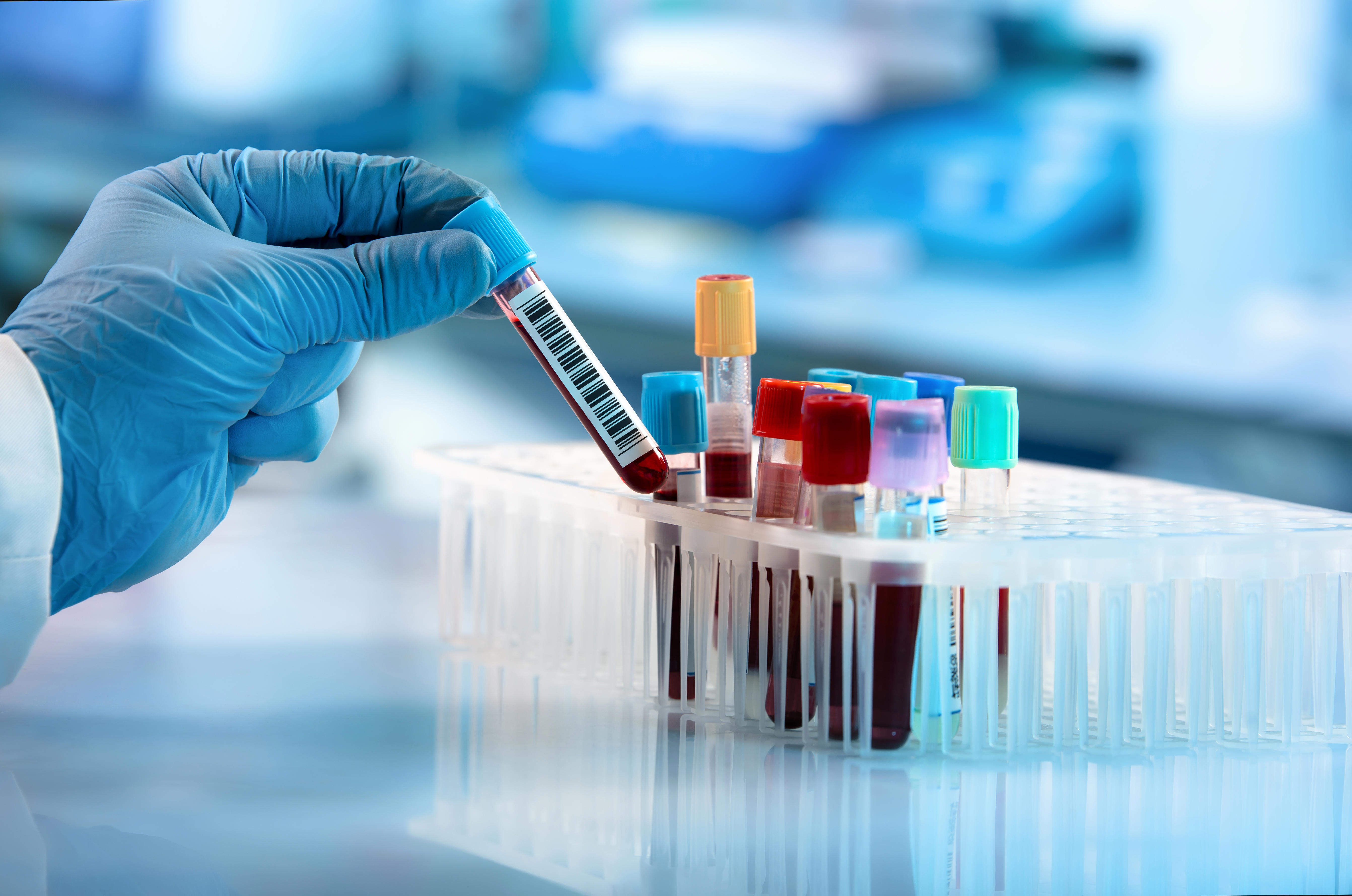 technician-holding-blood-tube-test-in-the-research-laboratory-doctor-hand-taking-a-blood-sample-tube-adobestock_211045328